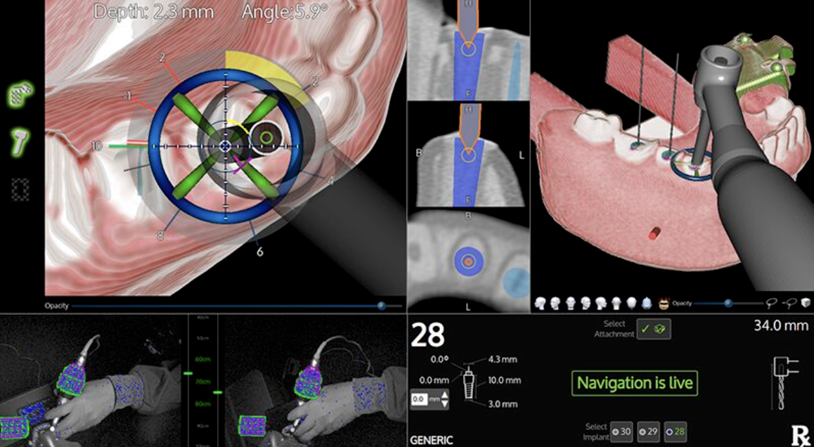 X-Guide Procedure Example